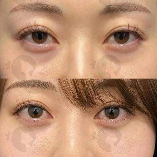 六、北京轻美颜（眼袋提升）医疗美容诊所价格表：（仅供参考）