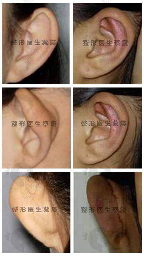 合肥智善美医疗美容招风耳矫正手术价格及特色