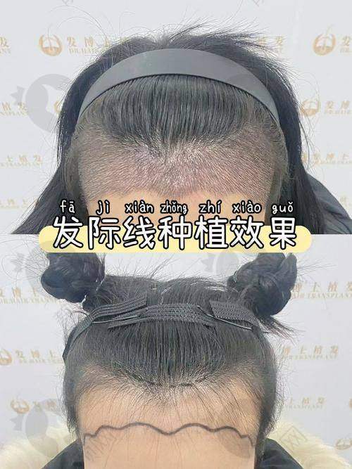 植发的性价比与总结