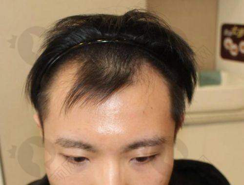 植发前的纠结与决心