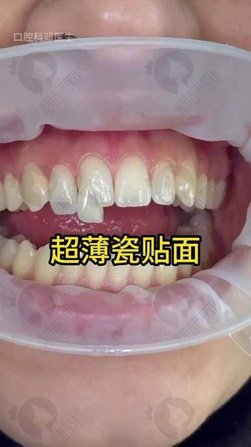 美加牙贴面长久使用的性价比优势