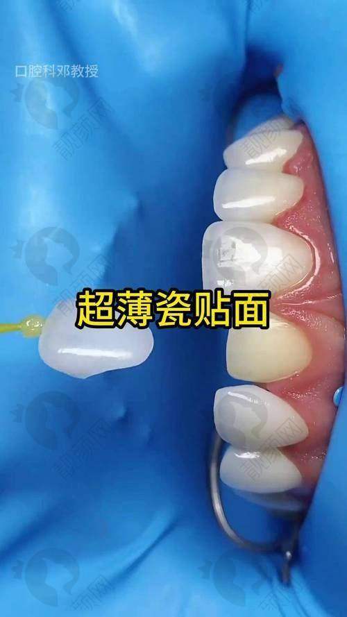 精细工艺助力美加牙贴面长久使用