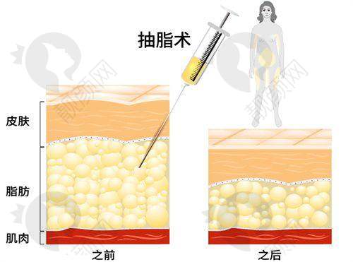 深圳阳光医疗美容医院：口碑良好的吸脂特色医院