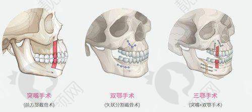 仙桃柏乐医疗美容：精细双眼皮技术显优势