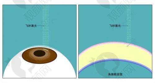 嘉兴爱尔眼科开展的项目及技术特点