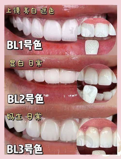 美加牙贴面与Max瓷贴面谁磨牙更少？——薄度大比拼