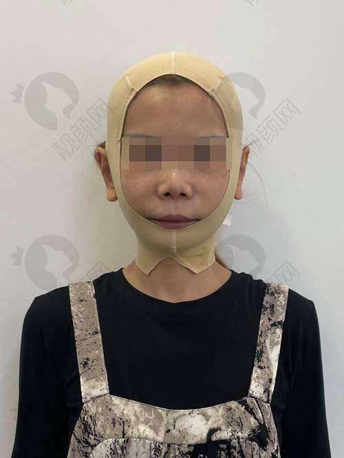 广州韩妃风筝小拉皮手术的价格