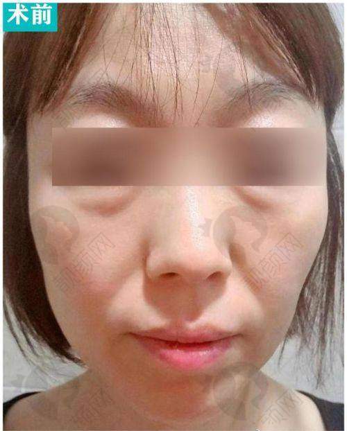 广州韩妃风筝小拉皮手术的技术特点