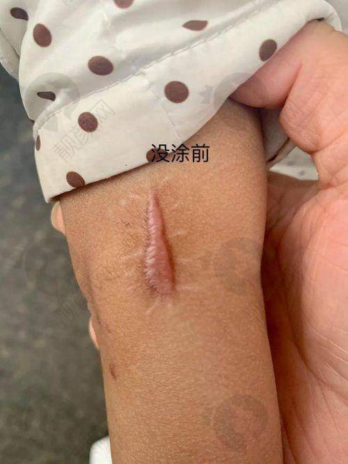 推荐给有疤痕困扰的你