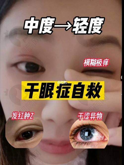 霰粒肿一年多微痛无肿，如何做出正确选择