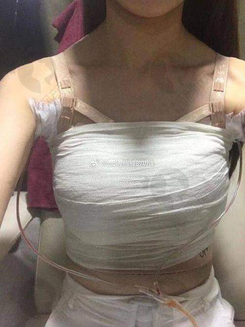 穆大力隆胸技术优势