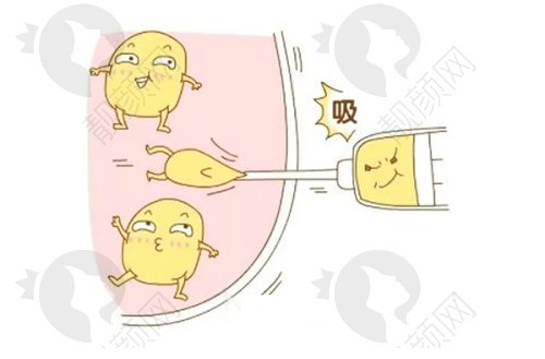 罗明生抽脂实例