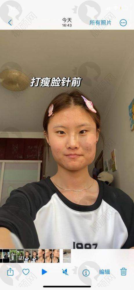 三、打瘦脸针的过程