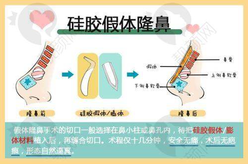 江苏淮安童颜焕美医疗假体隆鼻的真实评价