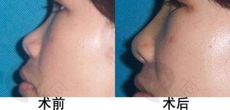 江苏淮安童颜焕美医疗假体隆鼻的优势