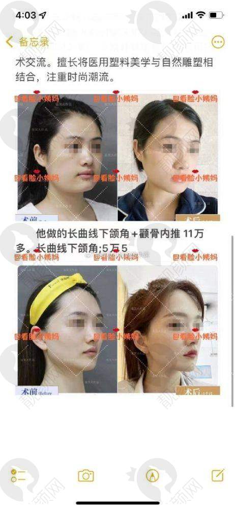 安可忍面部轮廓改脸型水平怎么样？