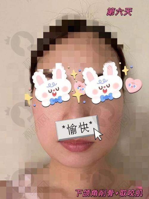 安可忍面部轮廓改脸型实例
