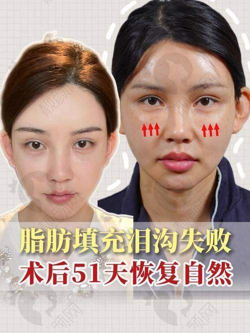 韦元强脂肪填充可靠吗？