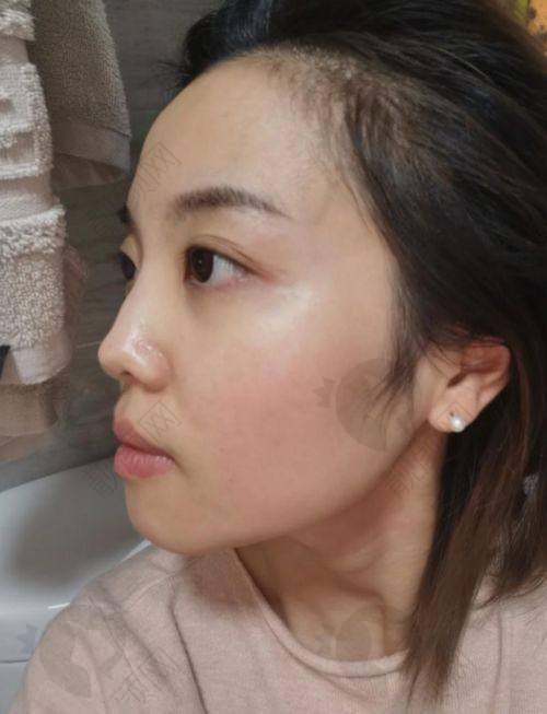 深圳安美聚光整形光子嫩肤项目真实评价