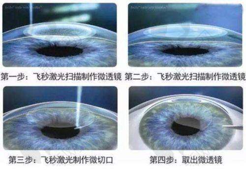 全飞秒4.0超短修复期的独特优势之适合急需用眼人群
