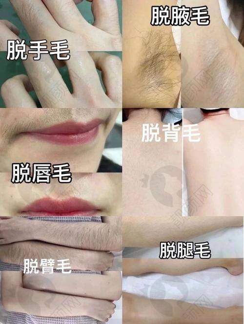 兰州梦想整形医院：多模式脱毛的美肤之选