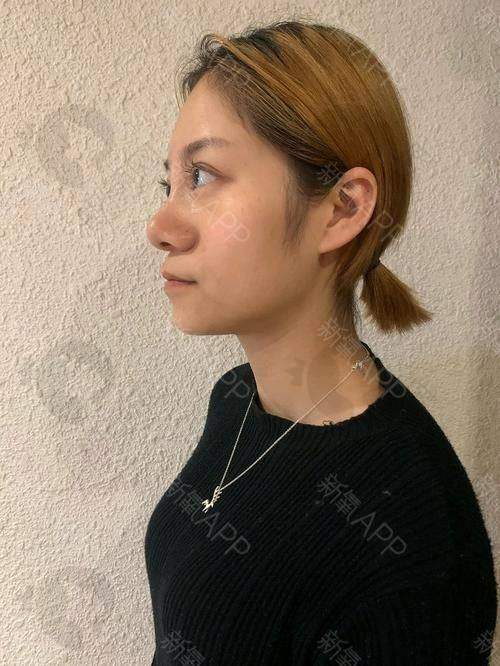 术后护理对成效维持时间的影响