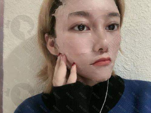 影响脂肪填充脸部成效维持时间的因素