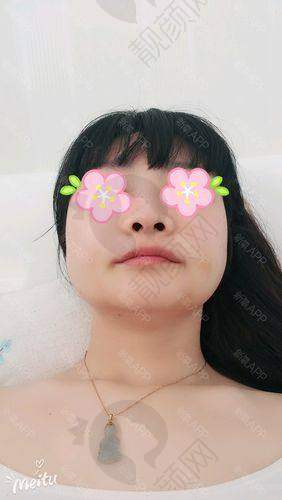 脂肪填充脸部的神奇成效
