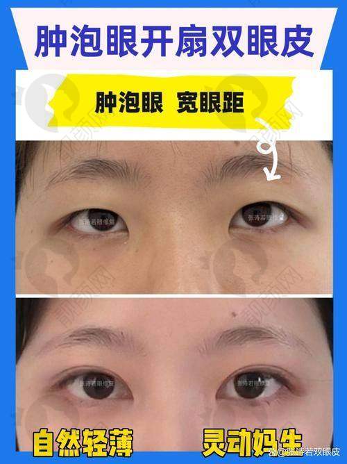 成都割双眼皮哪家医院可靠好？这5家公立三甲医院技术强口碑好，还附价格表！