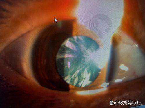 60/70/80岁老人做白内障手术有补贴：社保报销高，低保户免费！选口碑好的医院，电话速询