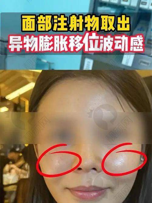 王阔远医生面部减容失败例子零记录，收费1.5W起，应急/奥尔贝德双院口碑超棒！