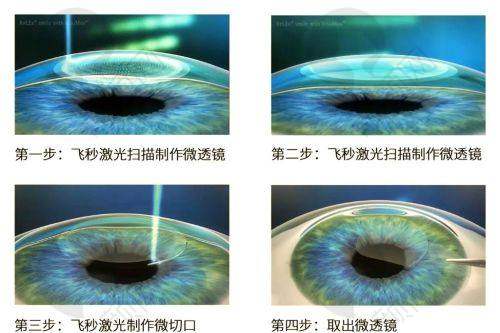 牡丹江爱尔眼科医院半飞秒精细化雕刻C+手术的成功实例