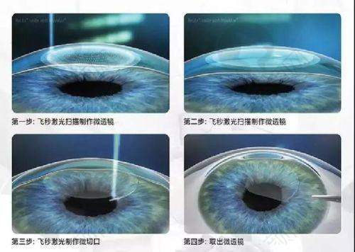 牡丹江爱尔眼科医院半飞秒精细化雕刻C+手术的技术特点
