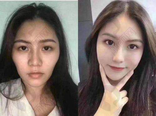 郑州脂肪填充有名整形医生排名大揭秘，脂肪填充价格参考