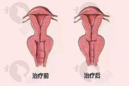 北京京民蒂凡妮(原志坚整形):逐层隧道式剥离,表情自然