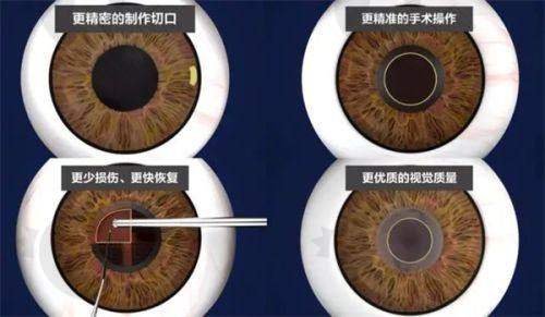 轻度白内障：药物延缓有妙招