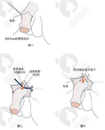 玻尿酸男性增大注射的维持时间差异咋回事？