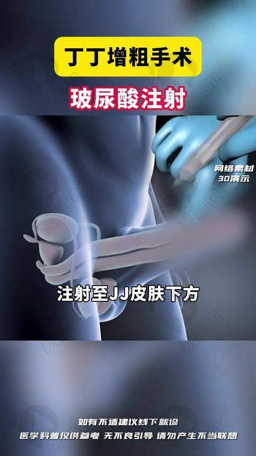 综合考量，如何选择适合自己的玻尿酸增大注射方案？