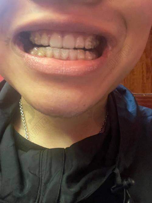 乌鲁木齐福宏林口腔隐形牙齿矫正的优势
