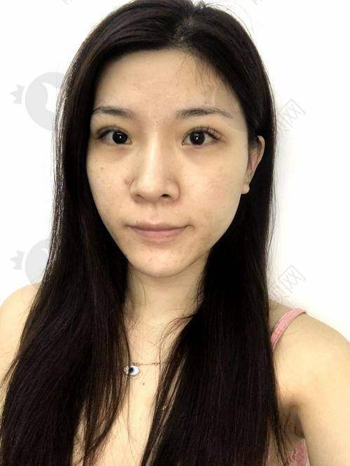 上海仁爱潘舒亚胶原蛋白填泪沟实例
