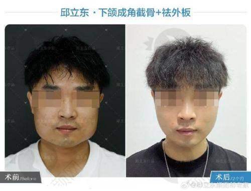 朱乐林磨骨实例
