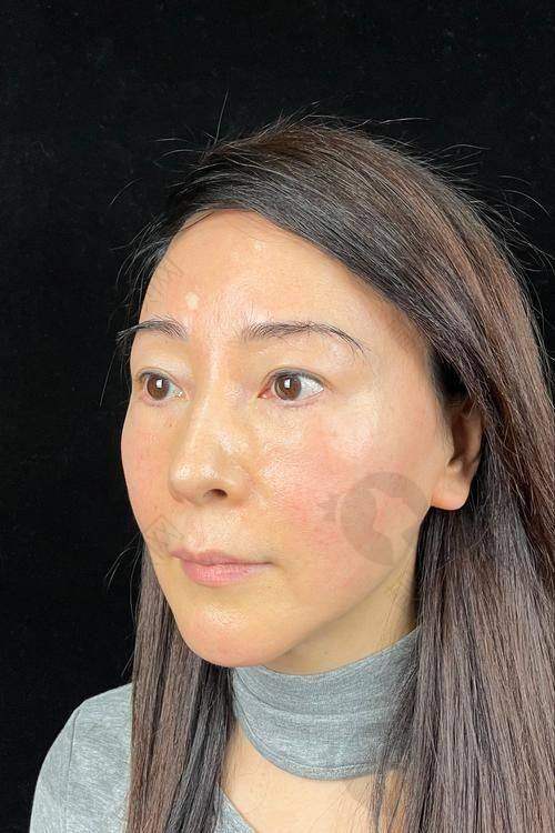 超声炮十天后对比照片：惊人的面部提升成效