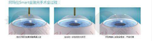 九江爱尔眼科医院白内障切除多种术式