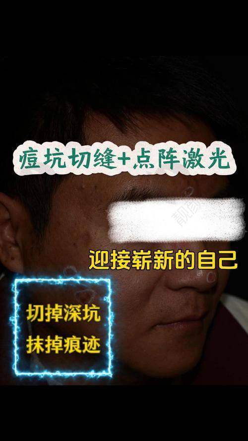 北京联合丽格第一整形医院点阵激光项目真实评价