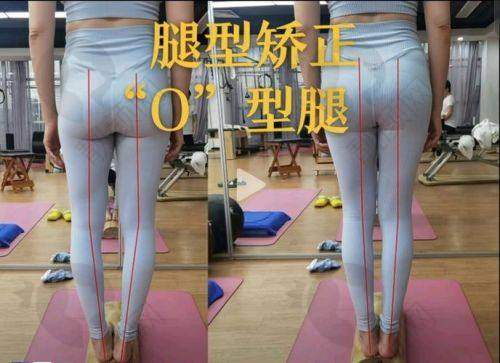 北京纯脂医疗美容：脂肪专科矫正腿型典范