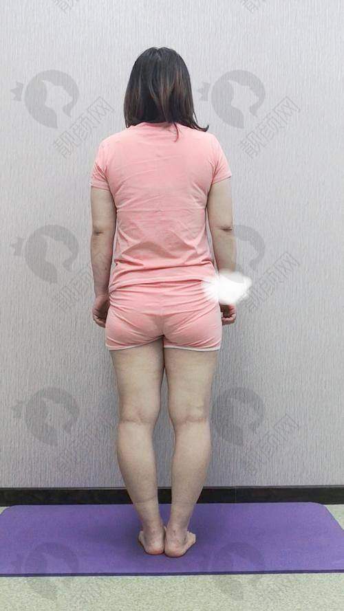 北京润美玉之光医疗美容：脂肪整形矫正腿型佼佼者