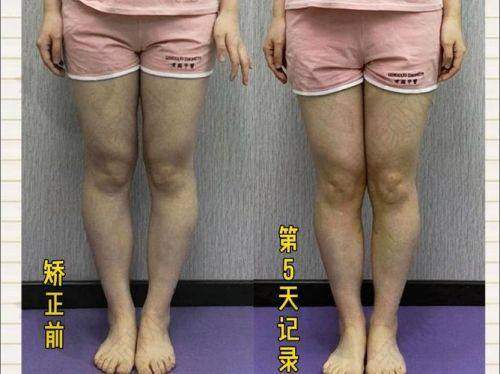 北京雅靓医疗美容：综合实力矫正腿型有保护