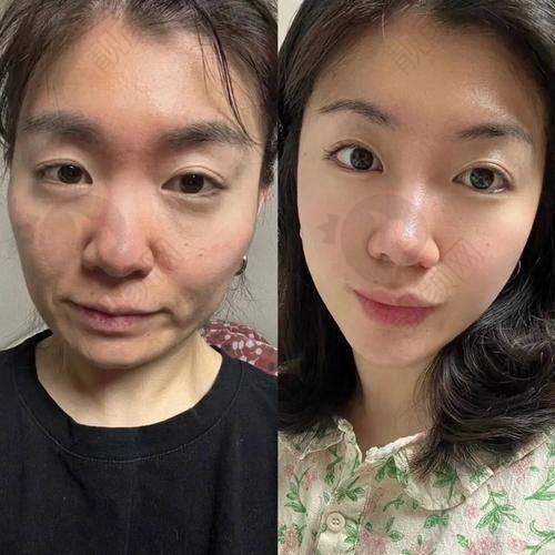 上海仁爱蹇洪苹果肌提升水平怎么样？