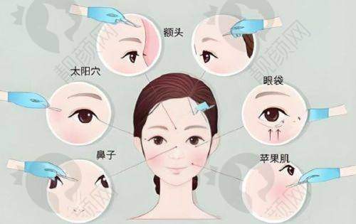 成都素美:值得信赖的帕克双眼皮技术