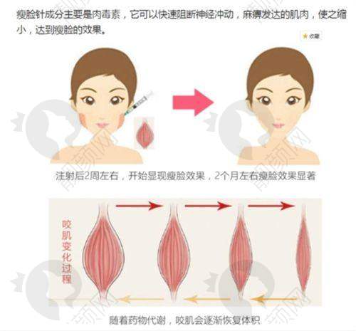 决定打瘦脸针